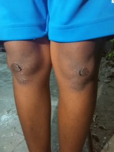 Kejam, Guru SMK di Betun Hukum Siswa Hingga Luka Robek di Lutut