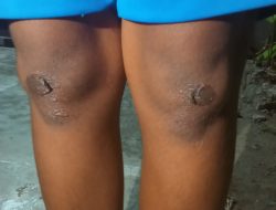 Kejam, Guru SMK di Betun Hukum Siswa Hingga Luka Robek di Lutut